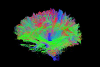 DTI scan of a brain