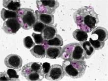 leishmaniasis 