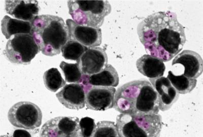leishmaniasis 