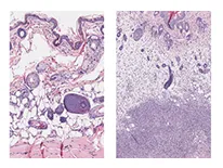 Tissue staining shows group A Streptococcus soft tissue infection at the cellular level. (L-R) Uninfected mouse tissue and mouse tissue 48 hours after infection. The dense dots indicate immune system cells that swarmed in to attempt to control the infection. The densest purple staining toward the bottom is necrotic tissue surrounding bacteria. Image: Joshua Leiberman, UMB (Click image to download hi-res version.)