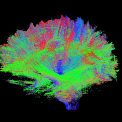 DTI scan of a brain